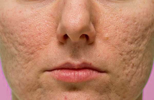 Acne Scars