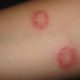 Ringworm