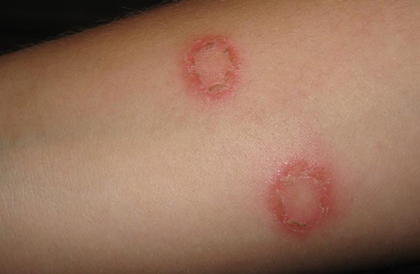Ringworm