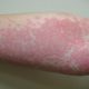 Drugs Allergy