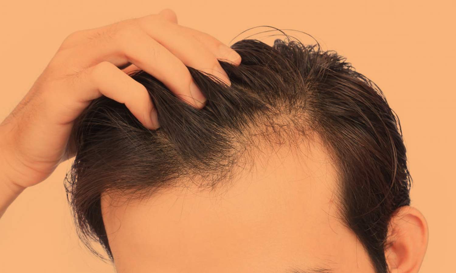 hairthinning