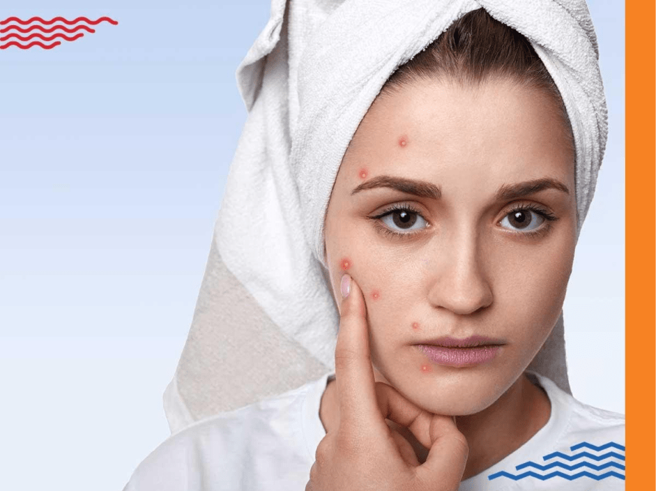 Acne Treatment in mumbai