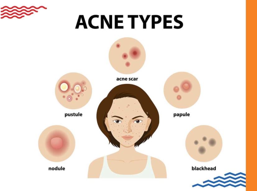 Acne Treatment in mumbai