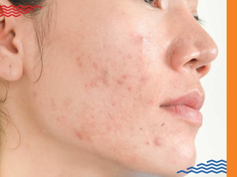 Acne Treatment in mumbai