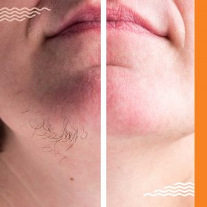 Chin Hair Facts: Why They Grow And How To Get Rid Of Them For Good |  Glamour UK
