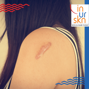 Raised (hypertrophic) Scars