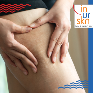 all-about-scars-stretch-marks